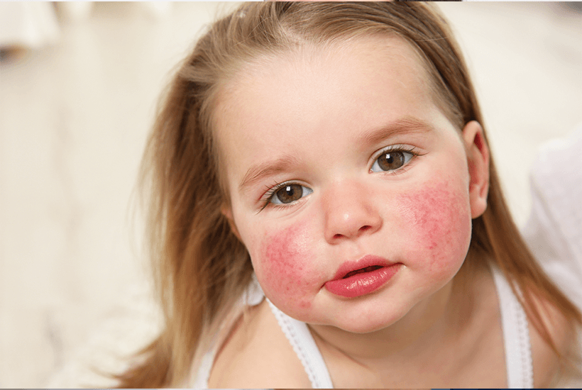 Atopik Dermatit (Egzama)  Nedir?  Çocuklarda Görülen İnek Sütü ve Çoklu Gıda Alerjileri